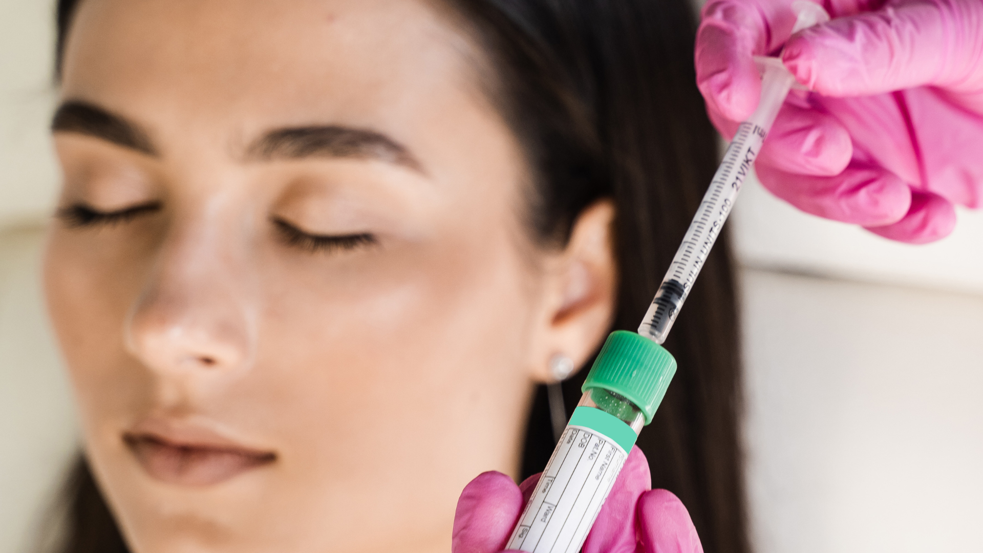 Aplicación de tratamiento facial tras obtener el plasma rico en plaquetas